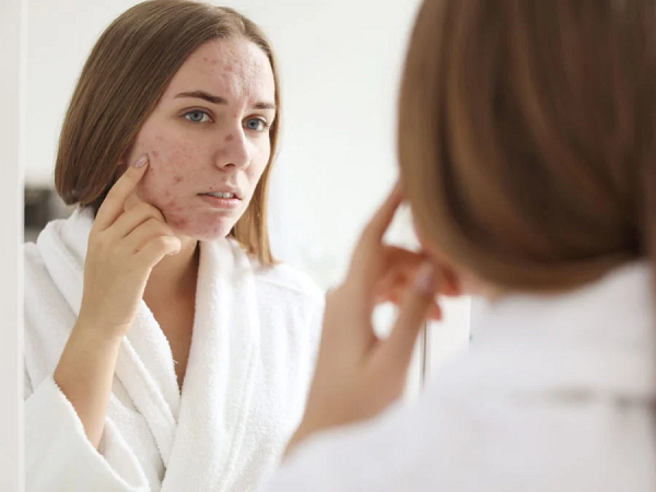 What’s causing my breakouts? And how can I treat them?