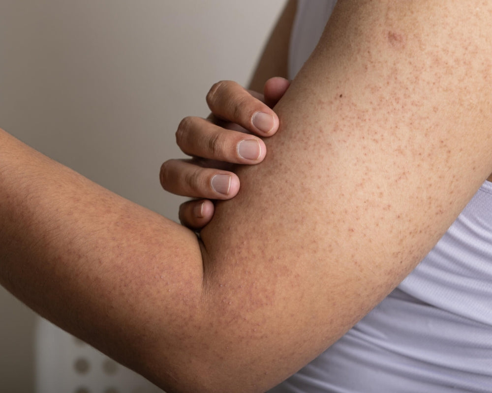 What is chicken skin? We answer your Keratosis Pilaris questions.